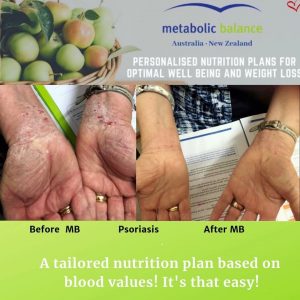 Carolyn 2 Psoriasis after 2 weeks on MB