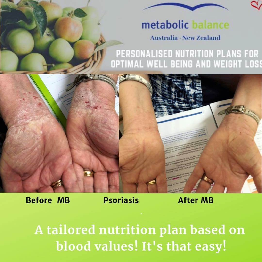 Carolyn 2 Psoriasis after 2 weeks on MB